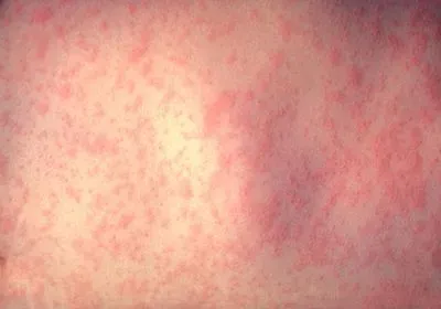 skin covered in small red bumps